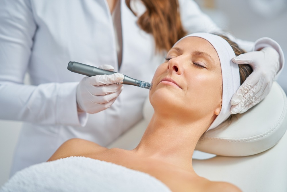 What is Microneedling Treatment?